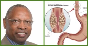 Kenyan Prof George Njoroge Bags KSh 446 Million Award to Fight Oesophageal Cancer